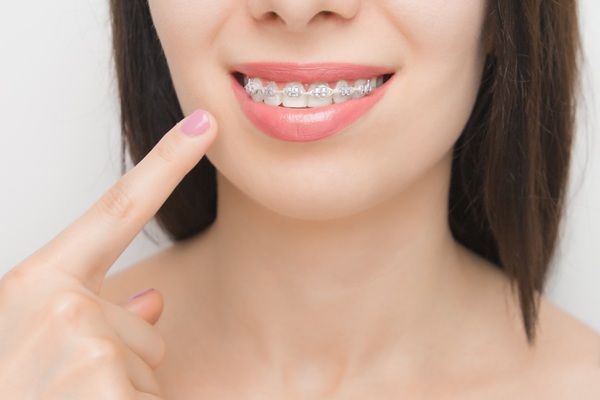 Clear Braces Vs  Aligners