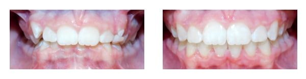 Before and after Anchored Orthodontics in Minnetonka, MN