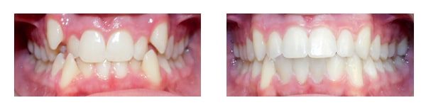Before and after Anchored Orthodontics in Minnetonka, MN