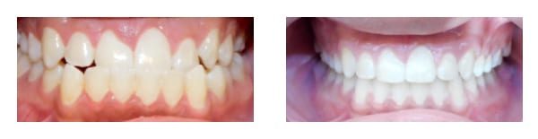 Before and after pictures Anchored Orthodontics in Minnetonka, MN