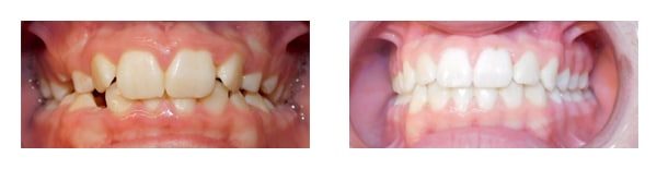 Before and after treatment Anchored Orthodontics in Minnetonka, MN