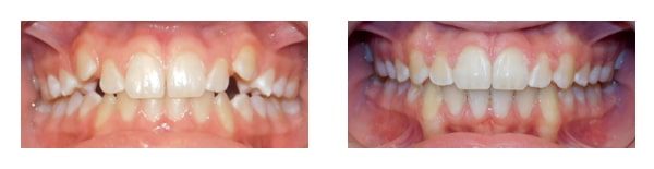 Before and after at Anchored Orthodontics in Minnetonka, MN