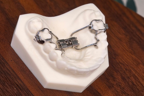 How Palate Expanders Work