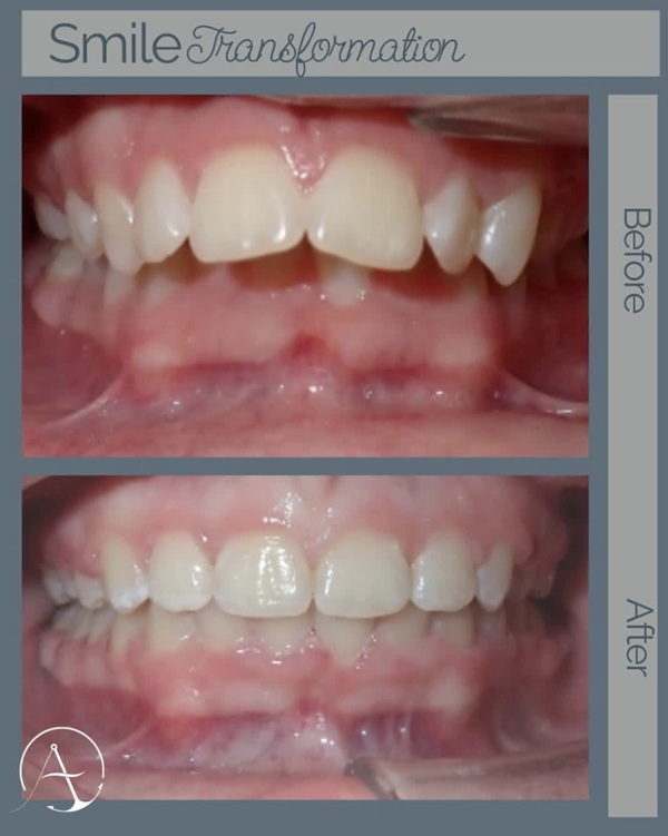 Comprehensive Braces; 24 months